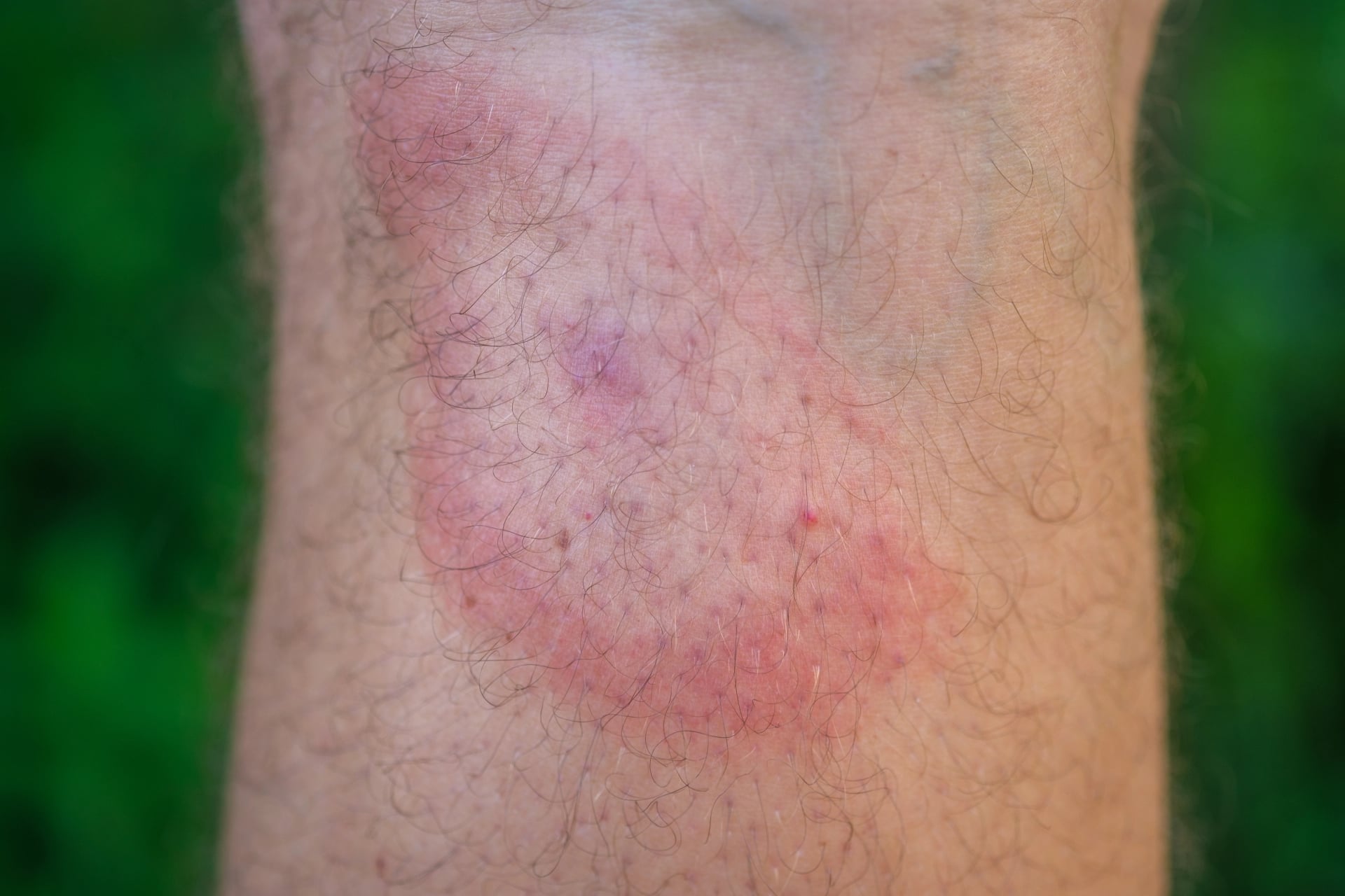 migrating erythema after a tick bite on a man's leg. a symptom of tick-borne borreliosis. a red ring in the form of a target on the leg