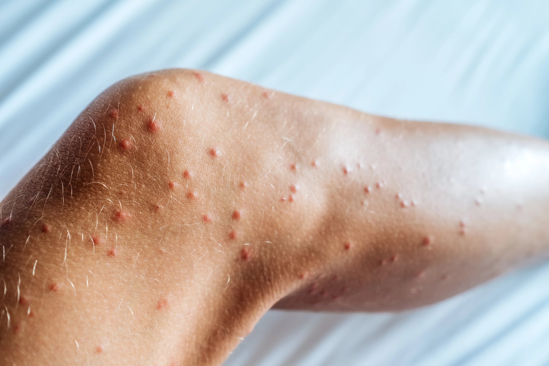 Skin damaged by insect bites